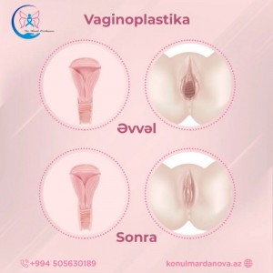 Vaginoplastika əməliyyatı